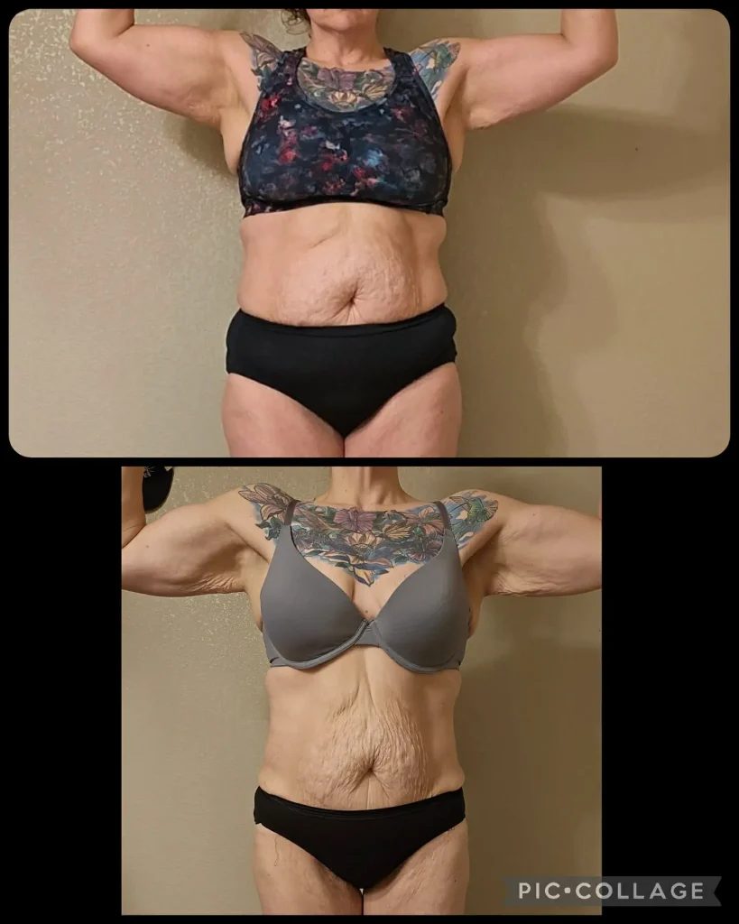 GLP-1 Therapy